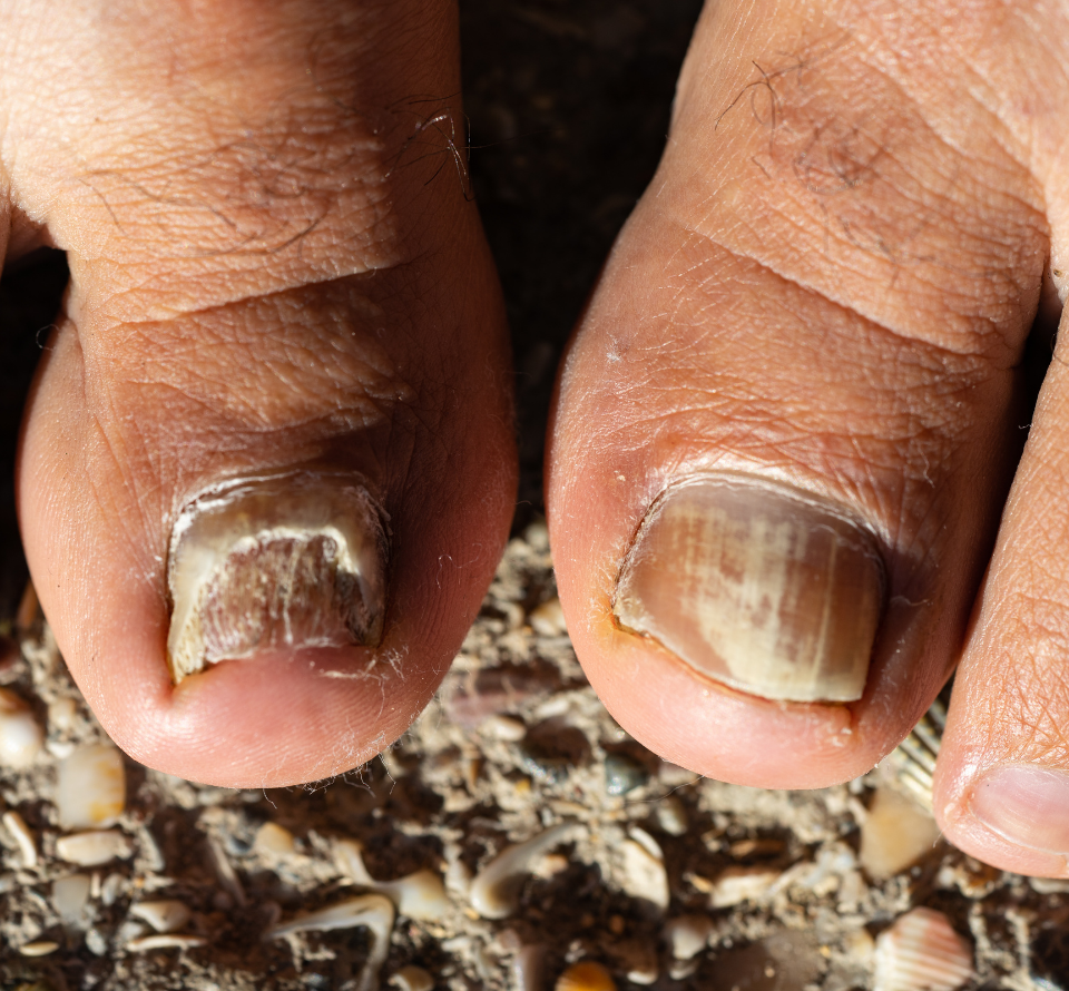 candida in toenails